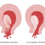 aborto-espontaneo