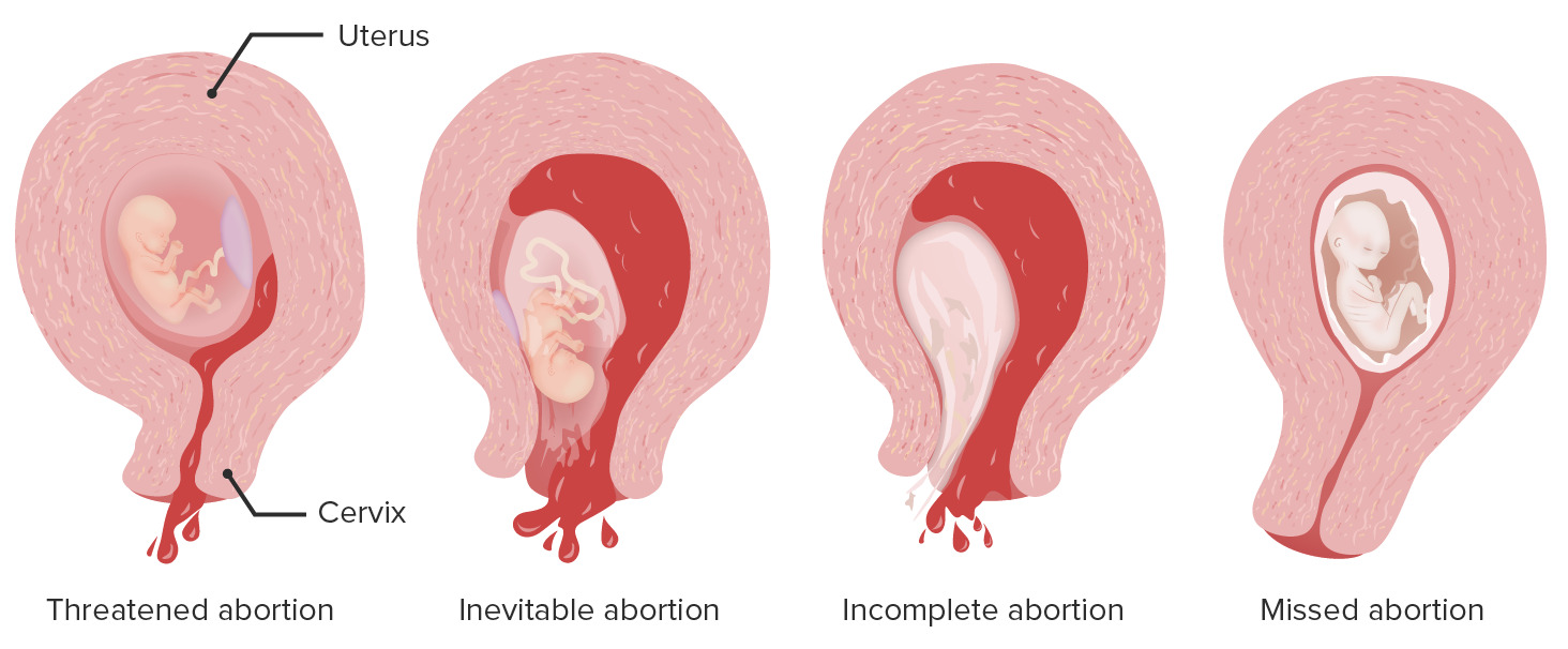 aborto-espontaneo